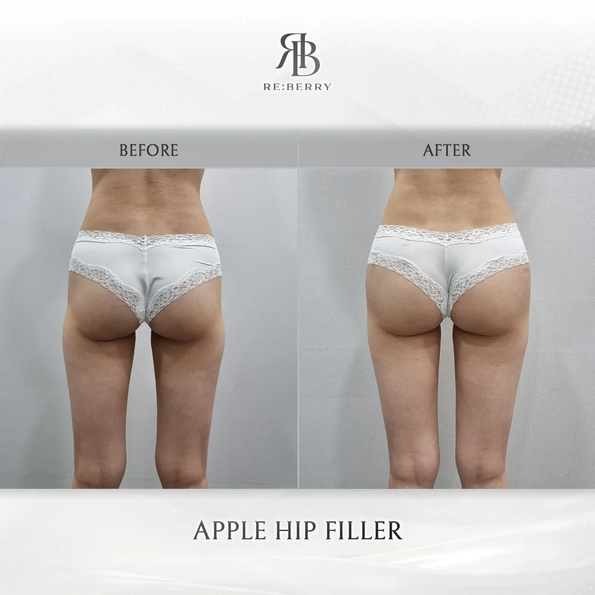 Before and after body treatment result at RE:BERRY Gangnam Aesthetic Clinic Seoul — real patient photo