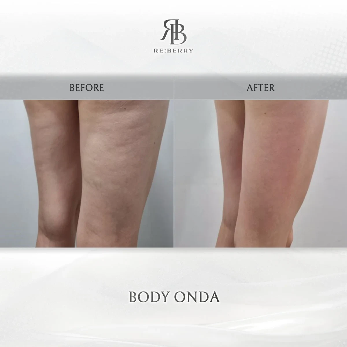 Before and after body treatment result at RE:BERRY Gangnam Aesthetic Clinic Seoul — real patient photo