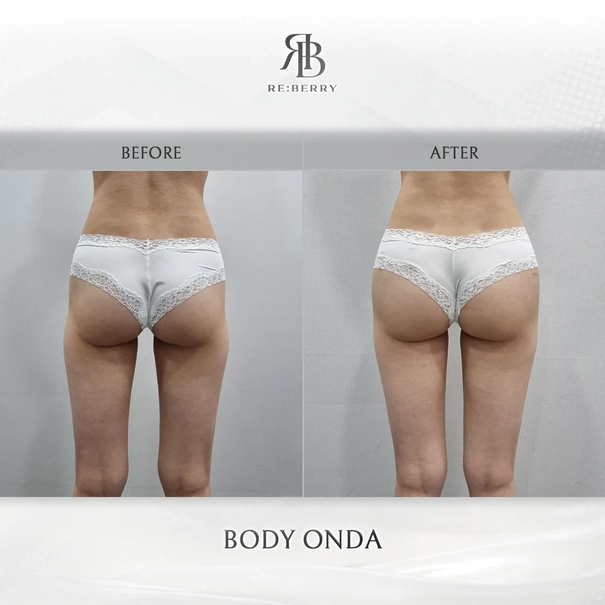 Before and after body treatment result at RE:BERRY Gangnam Aesthetic Clinic Seoul — real patient photo
