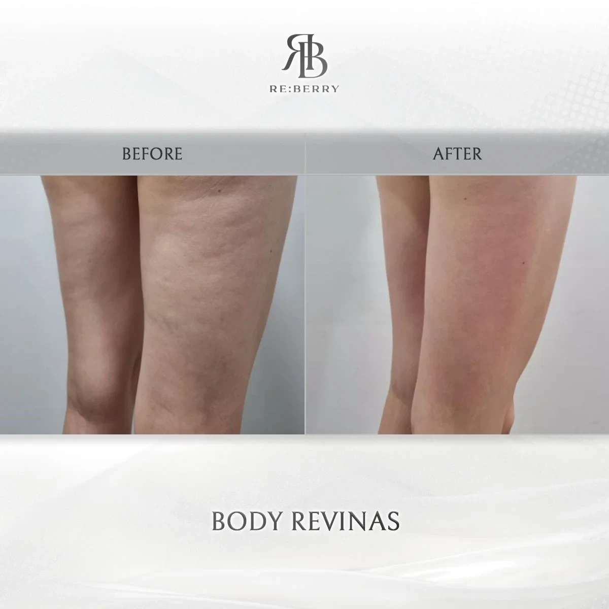 Before and after body treatment result at RE:BERRY Gangnam Aesthetic Clinic Seoul — real patient photo