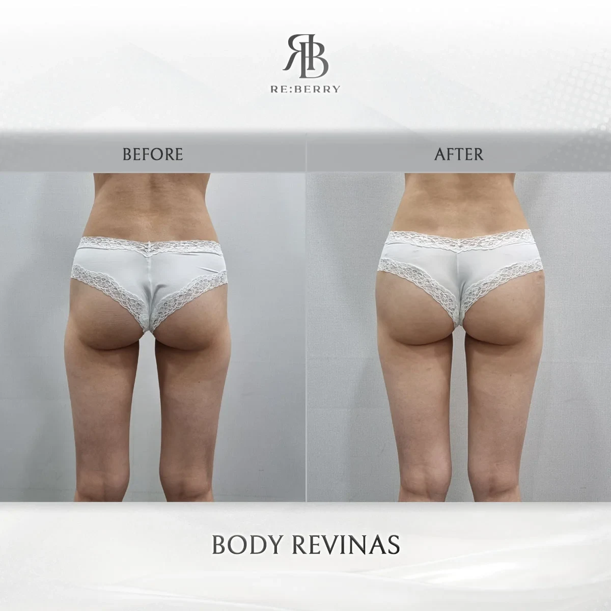 Before and after body treatment result at RE:BERRY Gangnam Aesthetic Clinic Seoul — real patient photo