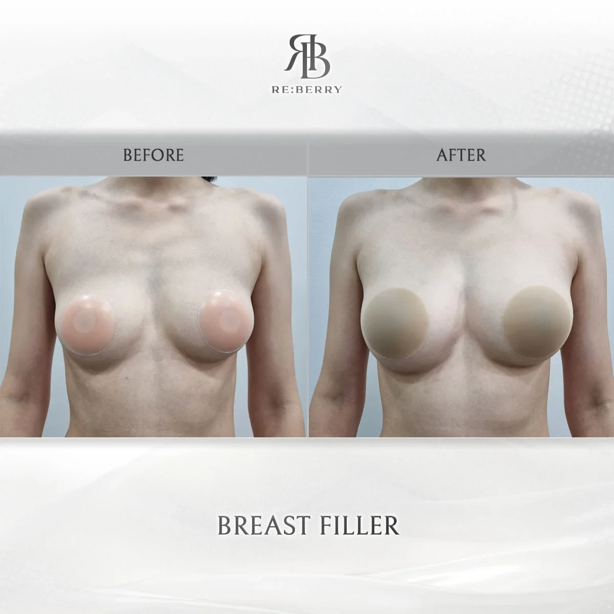 Before and after body treatment result at RE:BERRY Gangnam Aesthetic Clinic Seoul — real patient photo