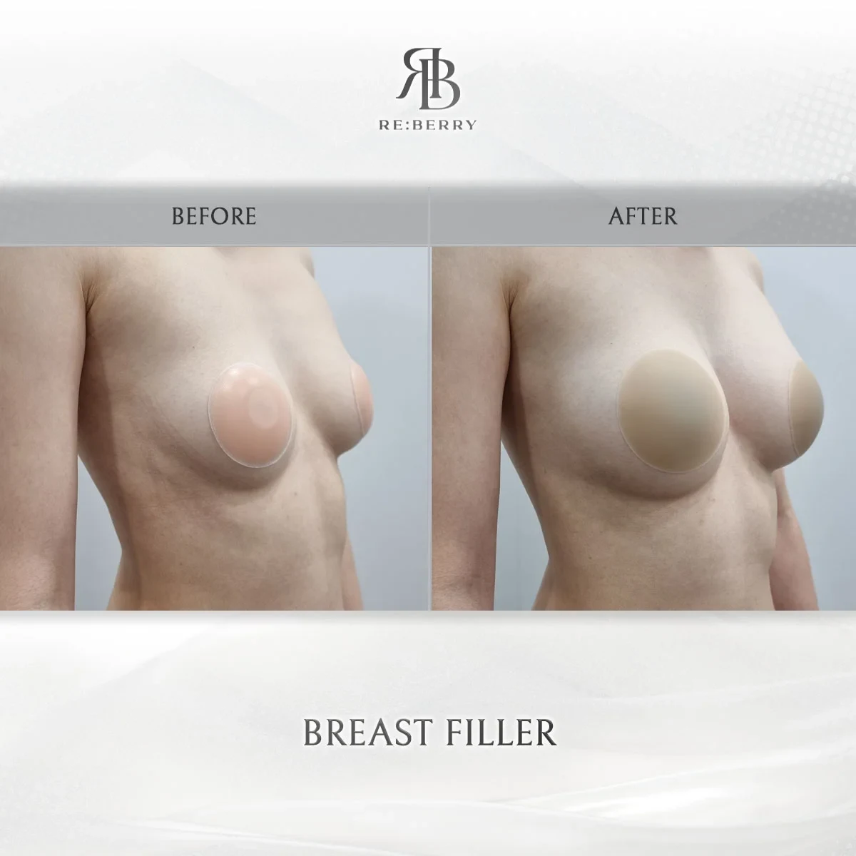 Before and after body treatment result at RE:BERRY Gangnam Aesthetic Clinic Seoul — real patient photo