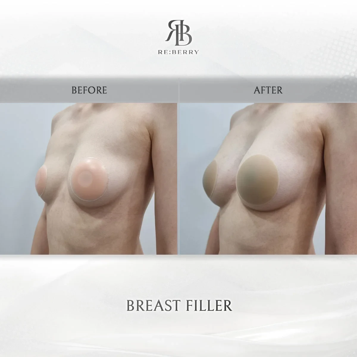 Before and after body treatment result at RE:BERRY Gangnam Aesthetic Clinic Seoul — real patient photo