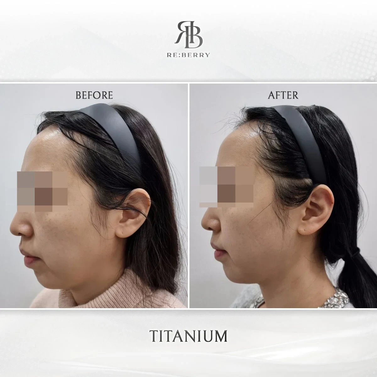 RE:BERRY กังนัม Titanium Lifting before & after