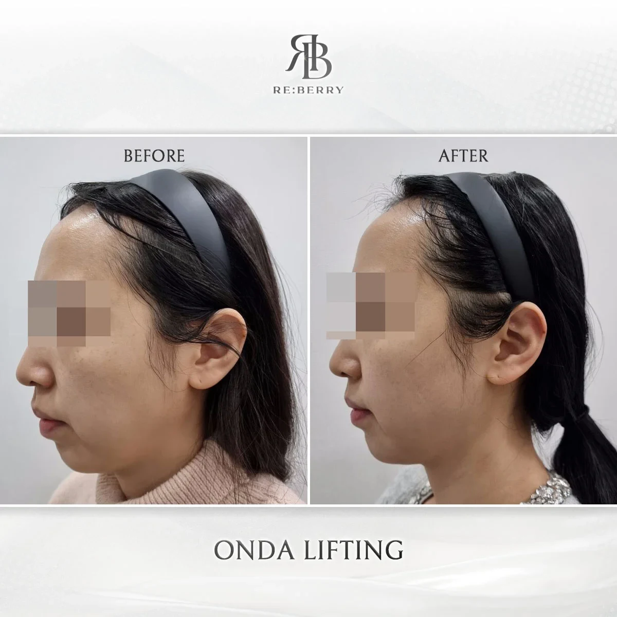 Before and after lifting treatment result at RE:BERRY Gangnam Aesthetic Clinic Seoul — real patient photo