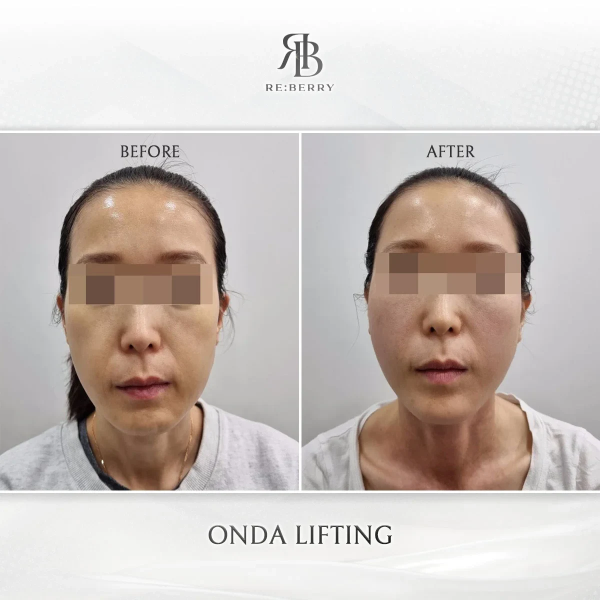 Before and after lifting treatment result at RE:BERRY Gangnam Aesthetic Clinic Seoul — real patient photo