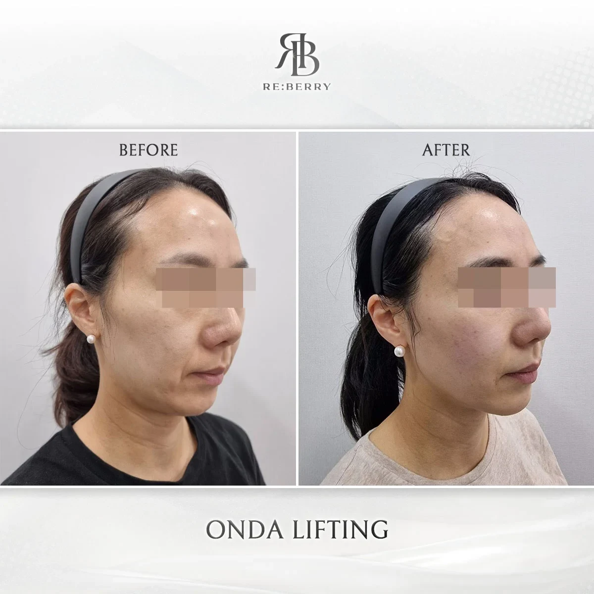 Before and after lifting treatment result at RE:BERRY Gangnam Aesthetic Clinic Seoul — real patient photo