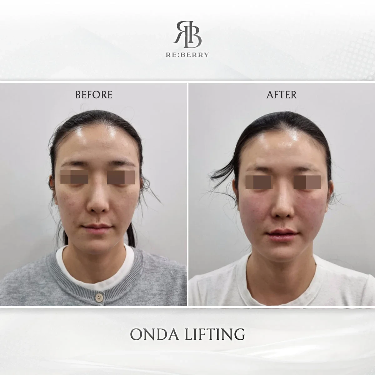 Before and after lifting treatment result at RE:BERRY Gangnam Aesthetic Clinic Seoul — real patient photo