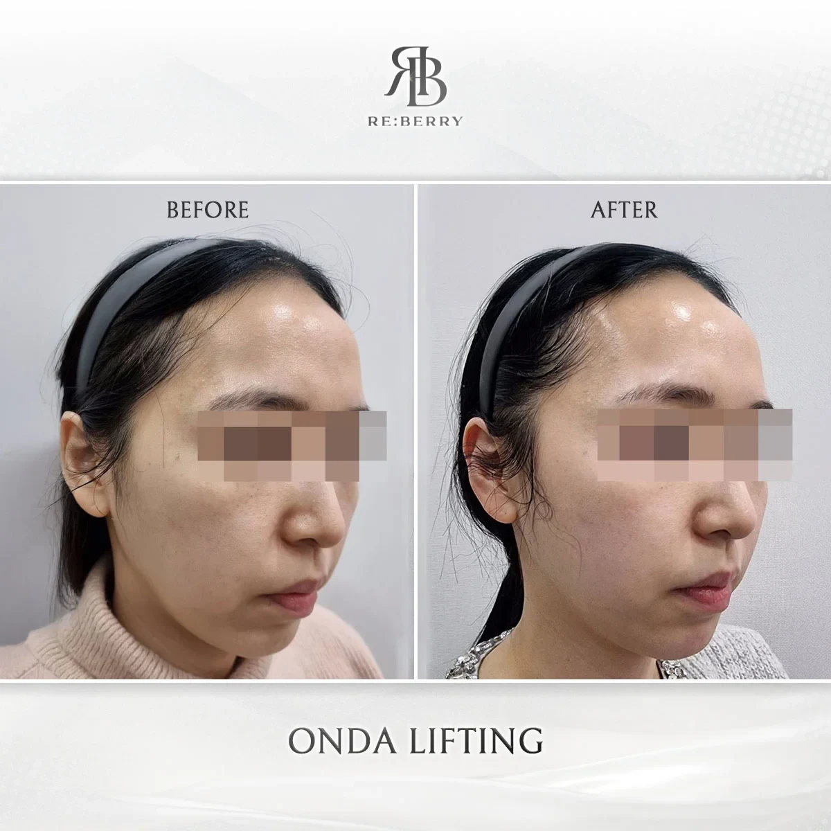 Before and after lifting treatment result at RE:BERRY Gangnam Aesthetic Clinic Seoul — real patient photo