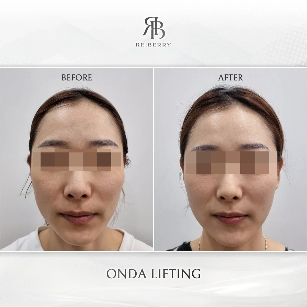 Before and after lifting treatment result at RE:BERRY Gangnam Aesthetic Clinic Seoul — real patient photo