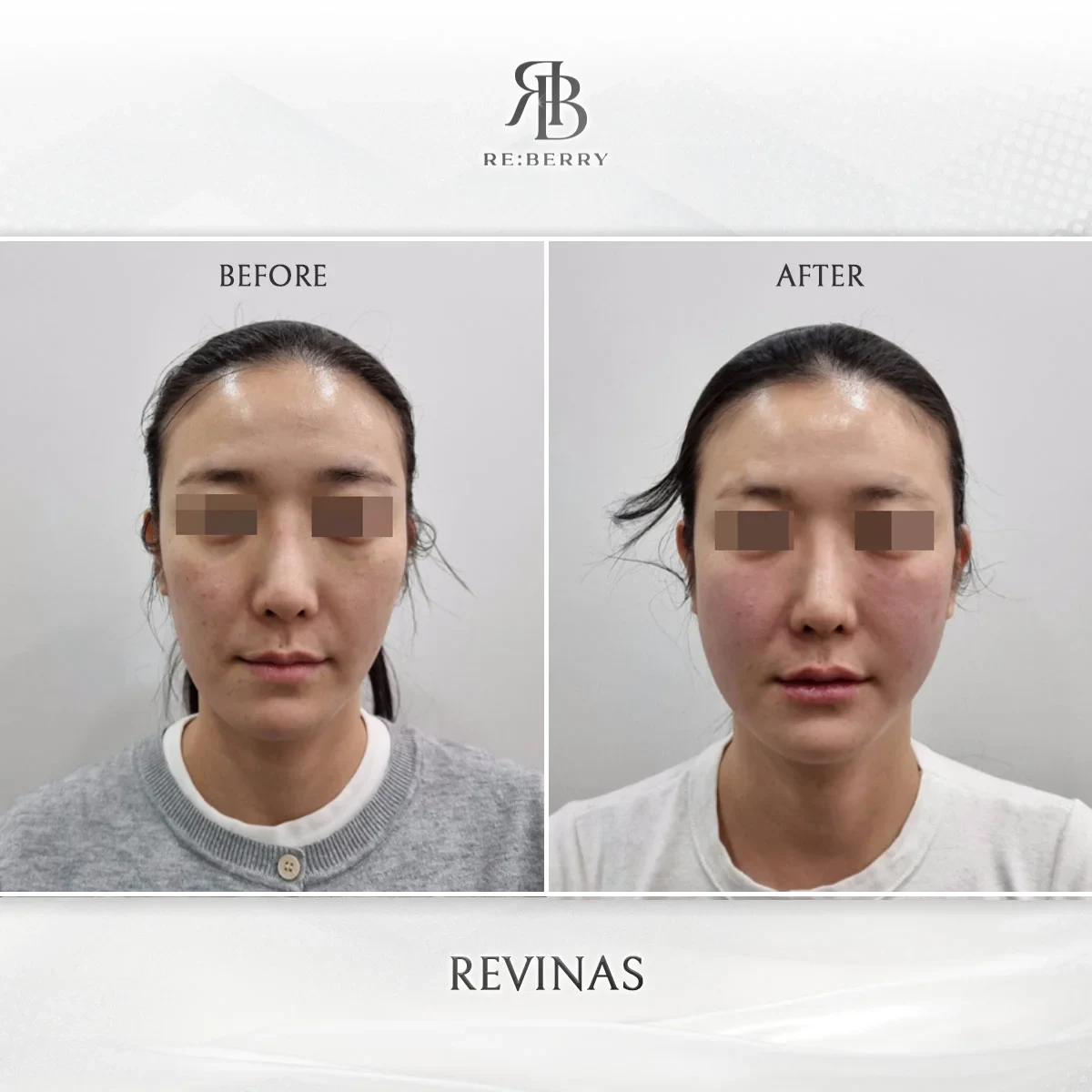 Before and after lifting treatment result at RE:BERRY Gangnam Aesthetic Clinic Seoul — real patient photo