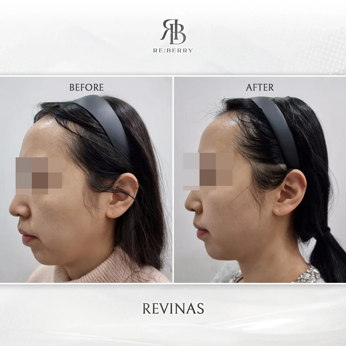 RE:BERRY กังนัม Revinas before & after