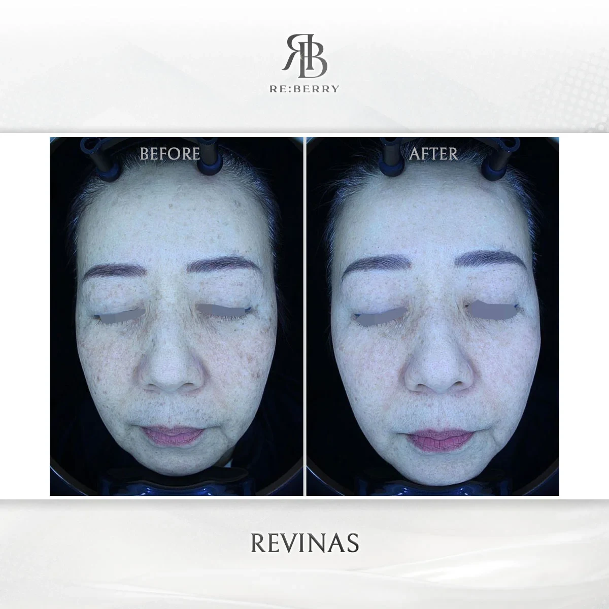 Before and after lifting treatment result at RE:BERRY Gangnam Aesthetic Clinic Seoul — real patient photo