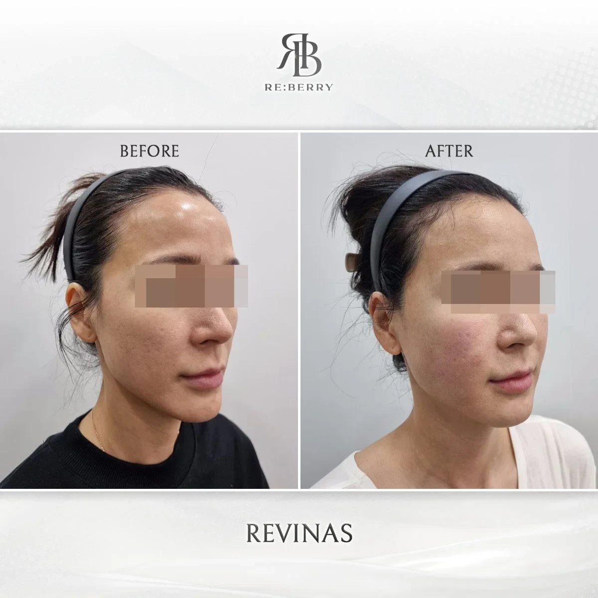 Before and after lifting treatment result at RE:BERRY Gangnam Aesthetic Clinic Seoul — real patient photo
