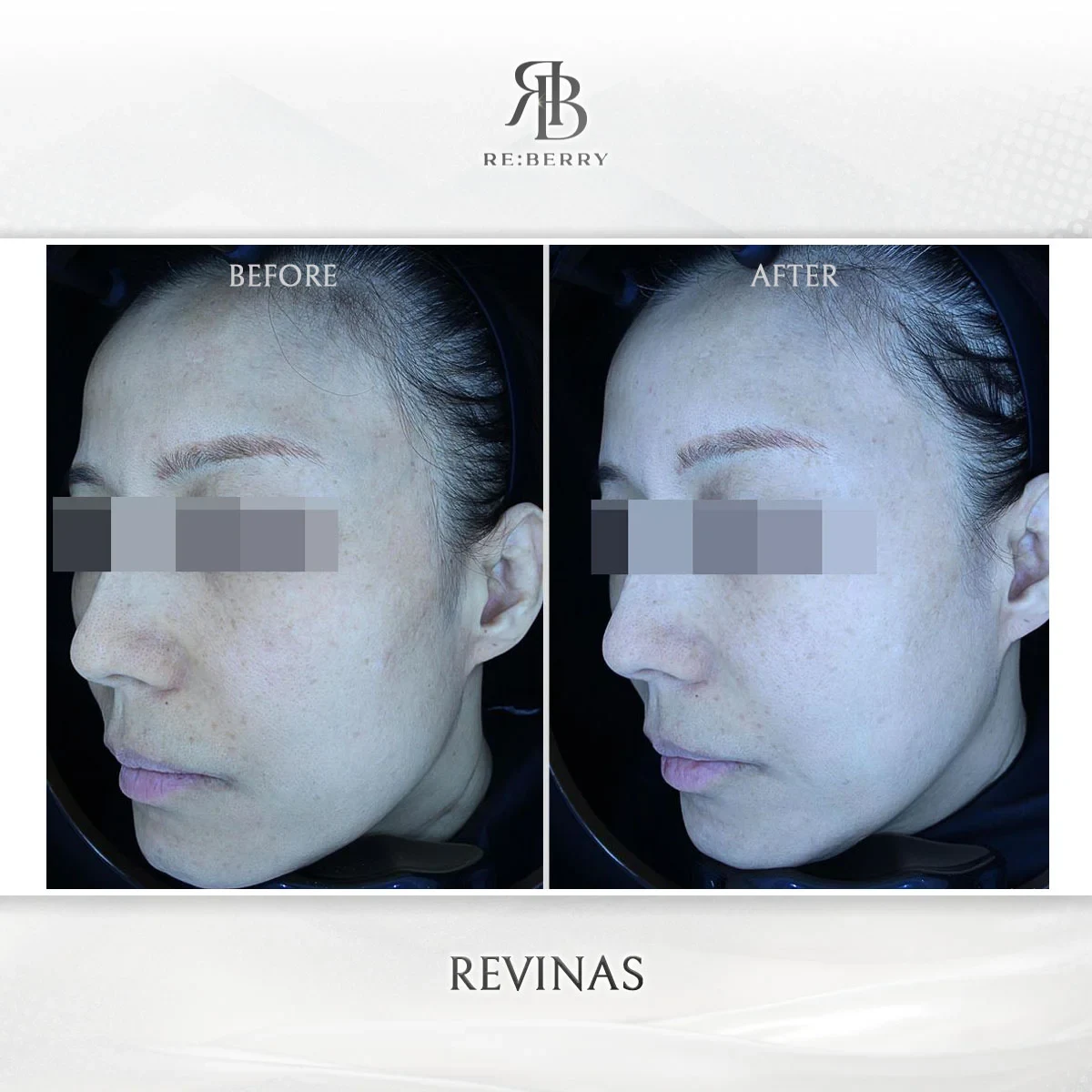Before and after lifting treatment result at RE:BERRY Gangnam Aesthetic Clinic Seoul — real patient photo