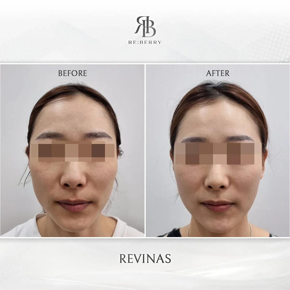 Before and after lifting treatment result at RE:BERRY Gangnam Aesthetic Clinic Seoul — real patient photo