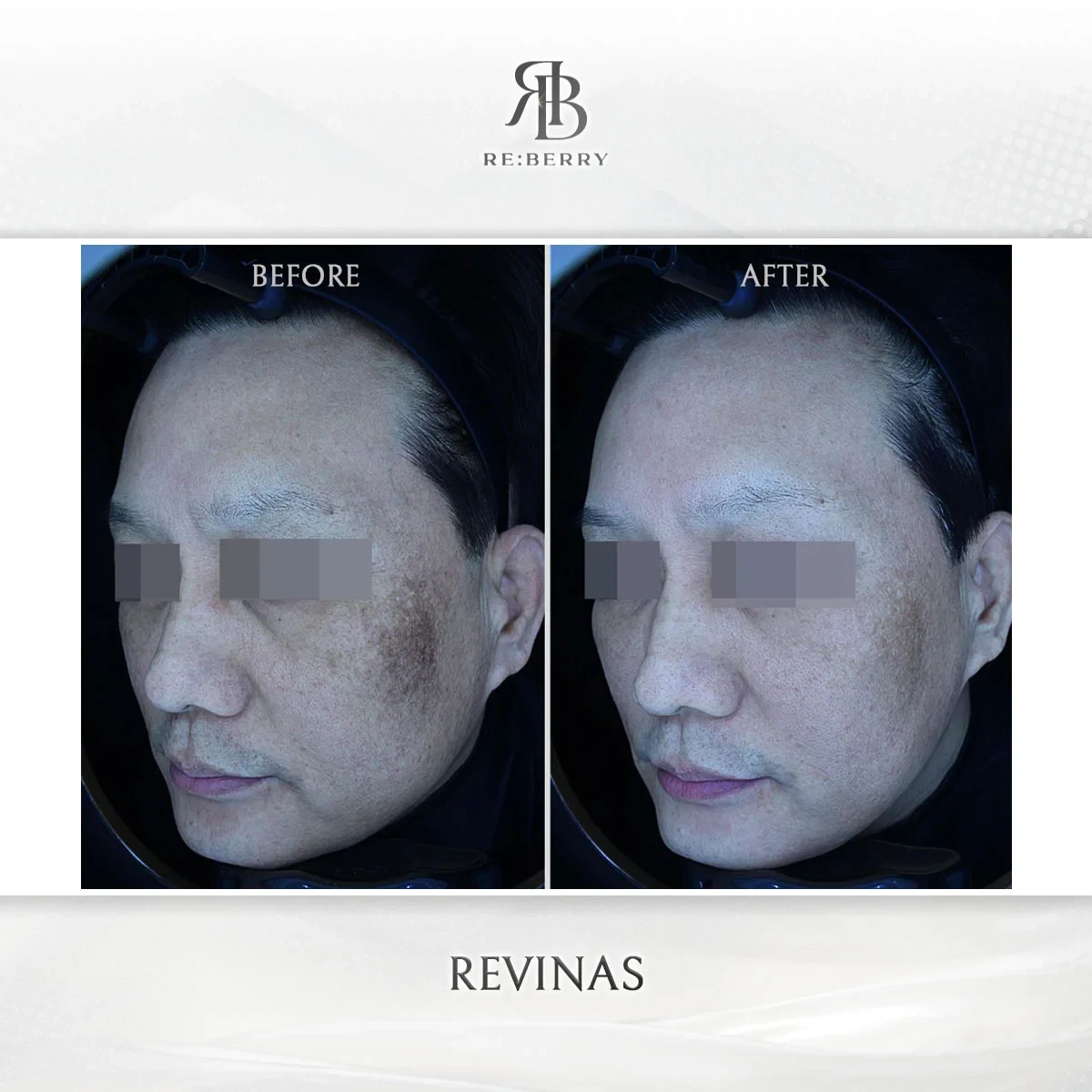 Before and after lifting treatment result at RE:BERRY Gangnam Aesthetic Clinic Seoul — real patient photo
