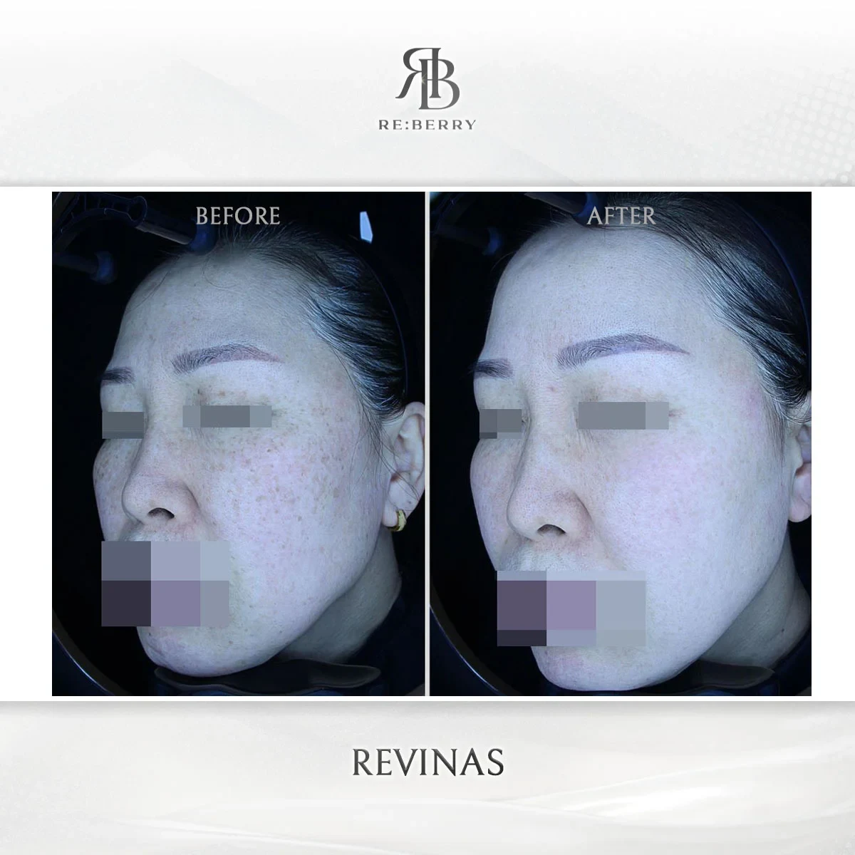 Before and after lifting treatment result at RE:BERRY Gangnam Aesthetic Clinic Seoul — real patient photo