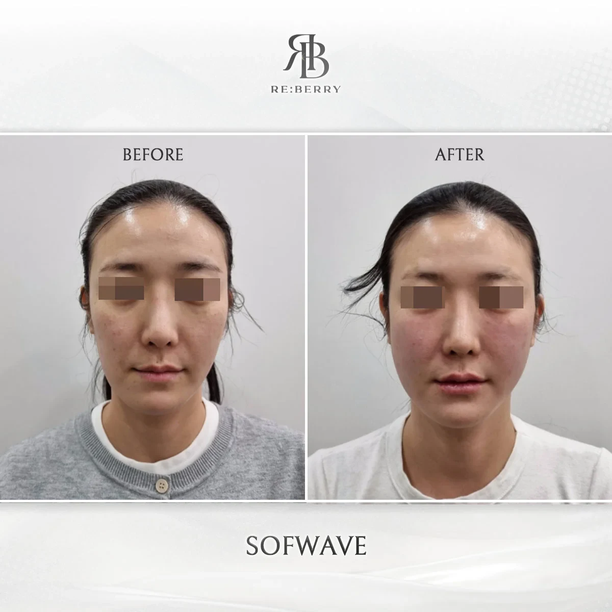 Before and after lifting treatment result at RE:BERRY Gangnam Aesthetic Clinic Seoul — real patient photo