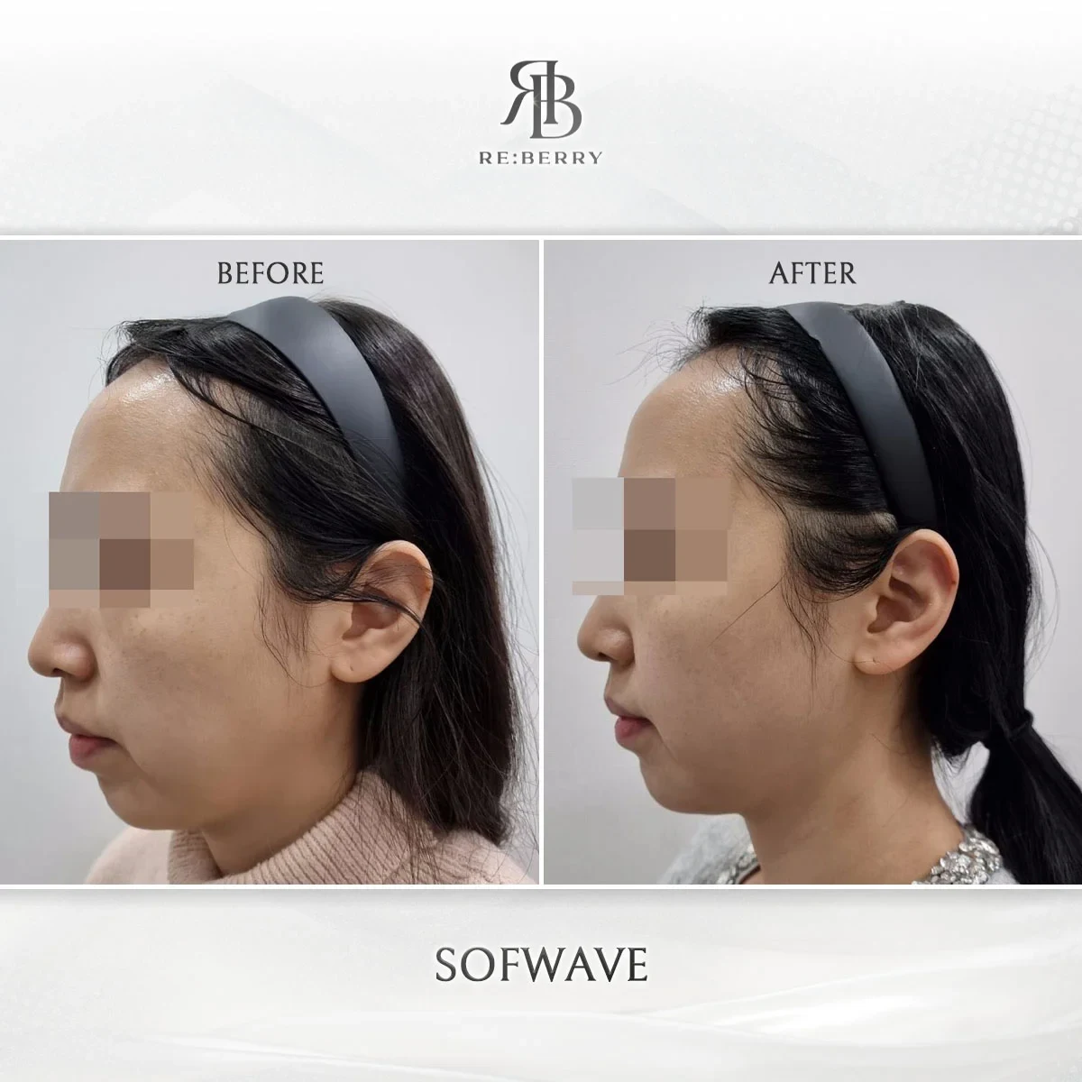 Before and after lifting treatment result at RE:BERRY Gangnam Aesthetic Clinic Seoul — real patient photo