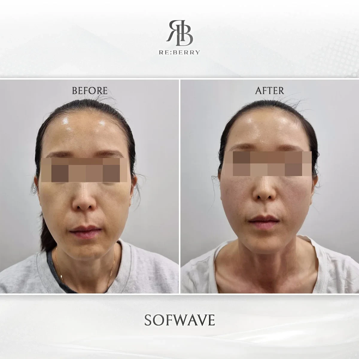 Before and after lifting treatment result at RE:BERRY Gangnam Aesthetic Clinic Seoul — real patient photo
