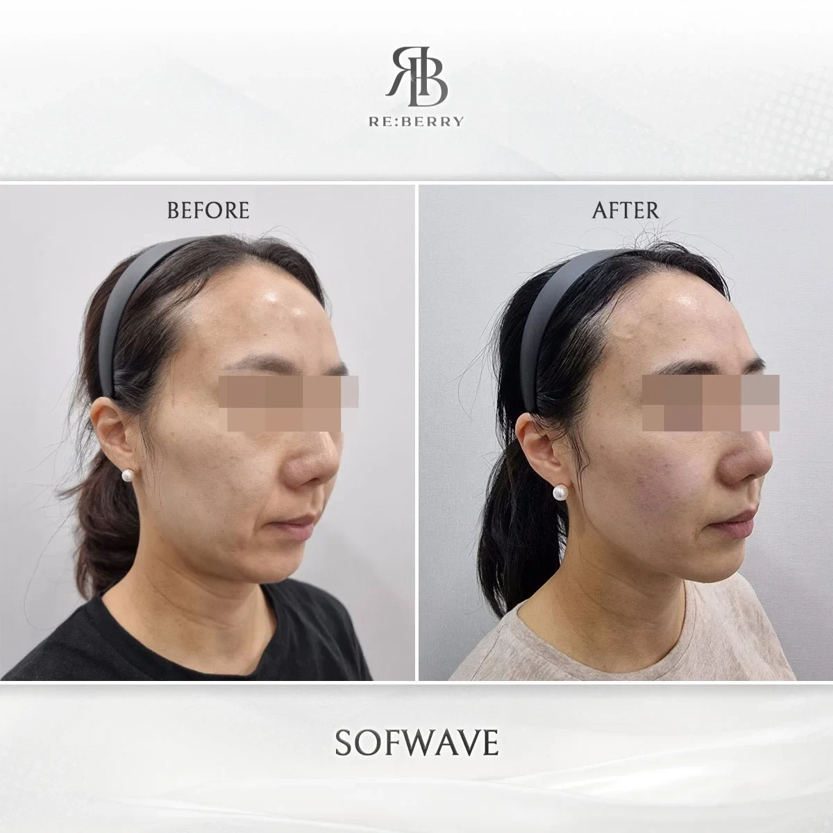 Before and after lifting treatment result at RE:BERRY Gangnam Aesthetic Clinic Seoul — real patient photo