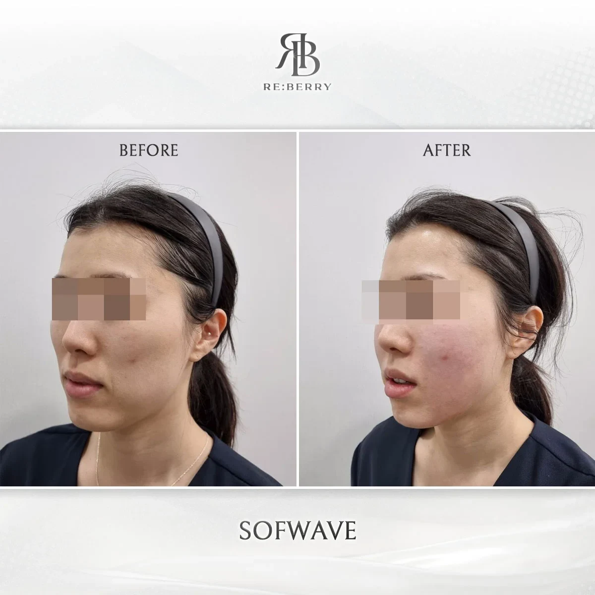 Before and after lifting treatment result at RE:BERRY Gangnam Aesthetic Clinic Seoul — real patient photo