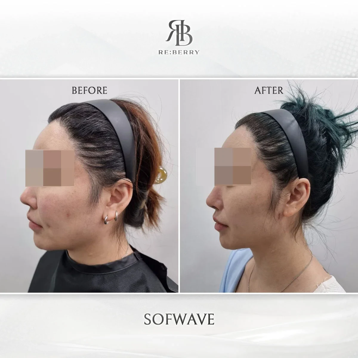 Before and after lifting treatment result at RE:BERRY Gangnam Aesthetic Clinic Seoul — real patient photo