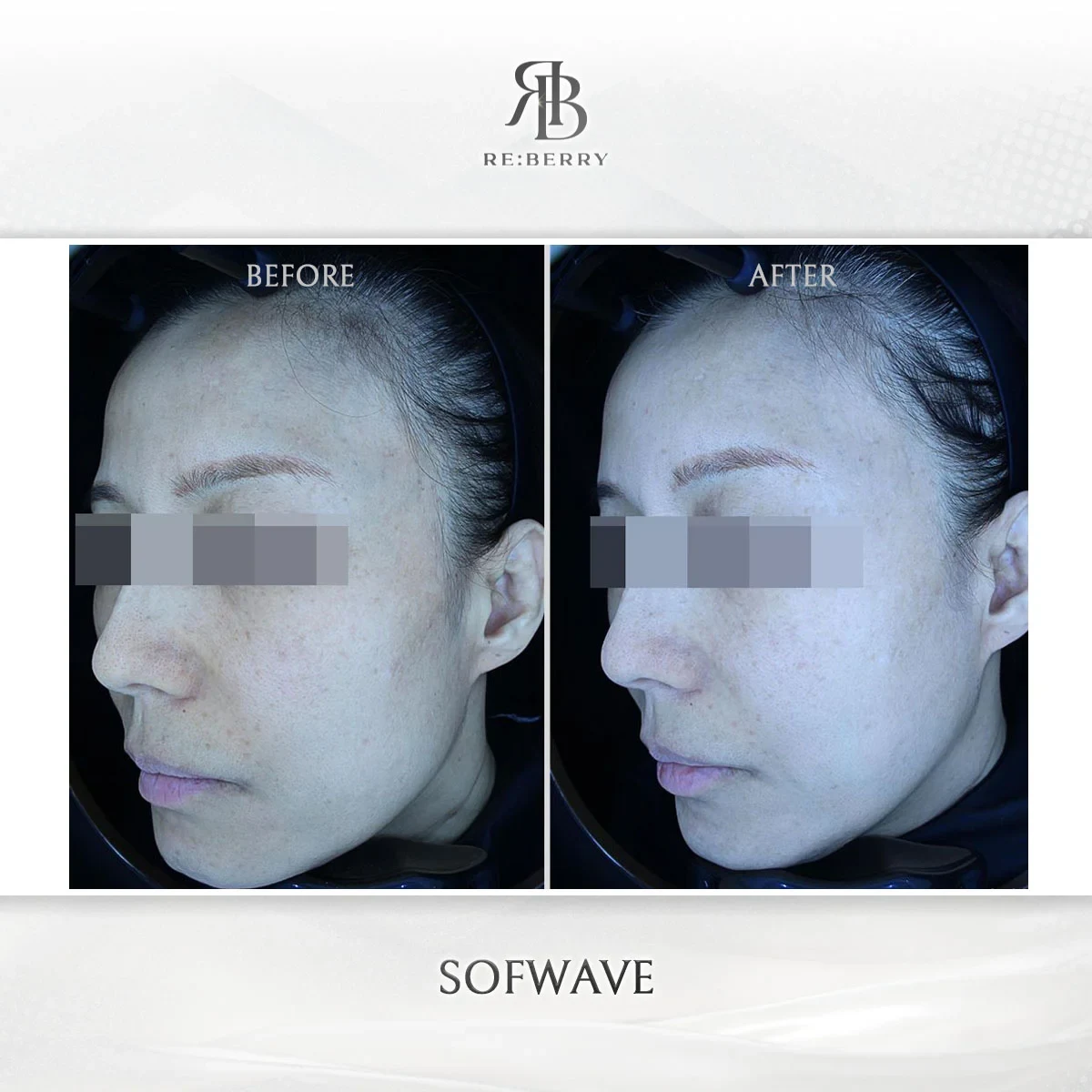 Before and after lifting treatment result at RE:BERRY Gangnam Aesthetic Clinic Seoul — real patient photo