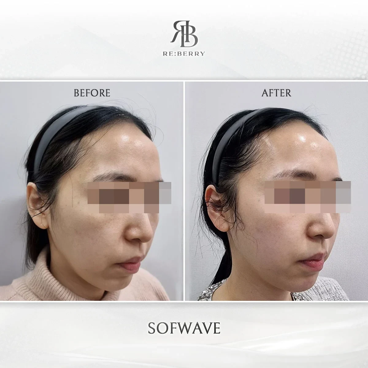 Before and after lifting treatment result at RE:BERRY Gangnam Aesthetic Clinic Seoul — real patient photo