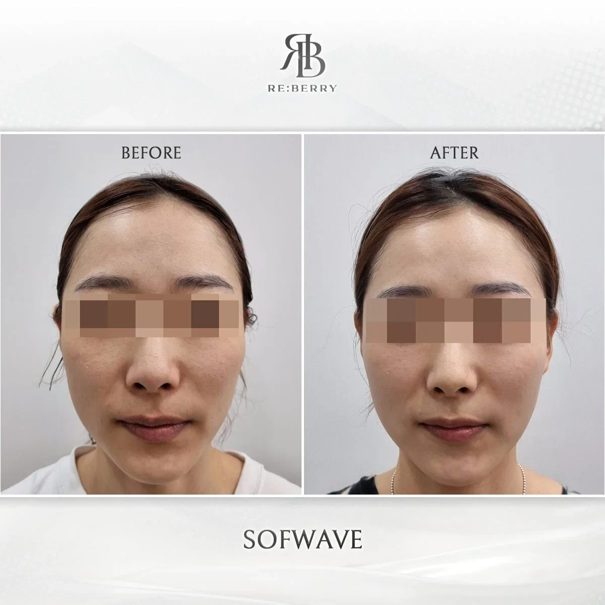 Before and after lifting treatment result at RE:BERRY Gangnam Aesthetic Clinic Seoul — real patient photo