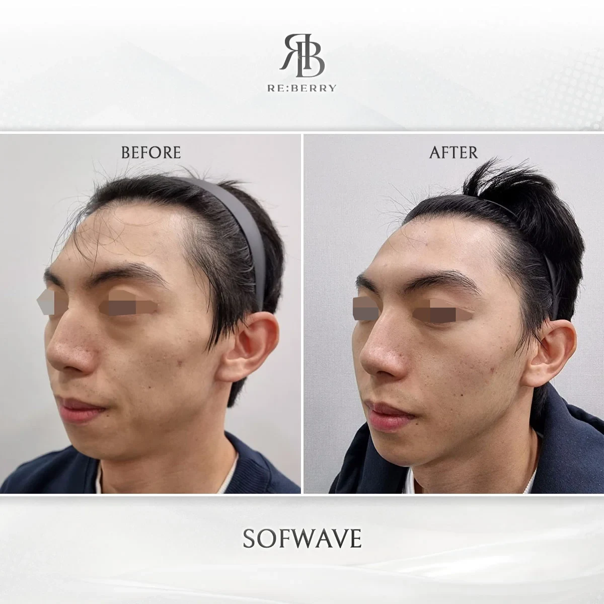 Before and after lifting treatment result at RE:BERRY Gangnam Aesthetic Clinic Seoul — real patient photo