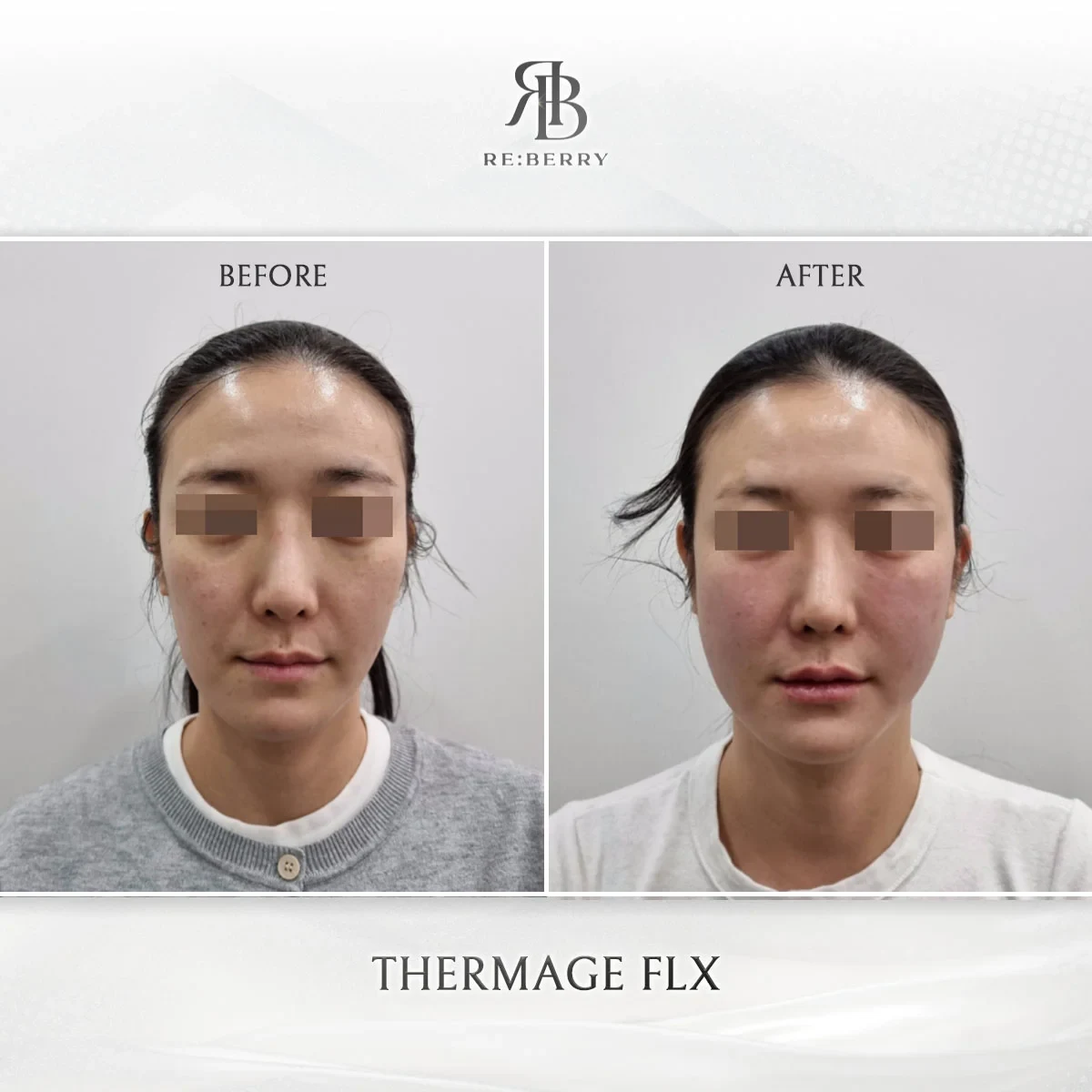 Before and after lifting treatment result at RE:BERRY Gangnam Aesthetic Clinic Seoul — real patient photo