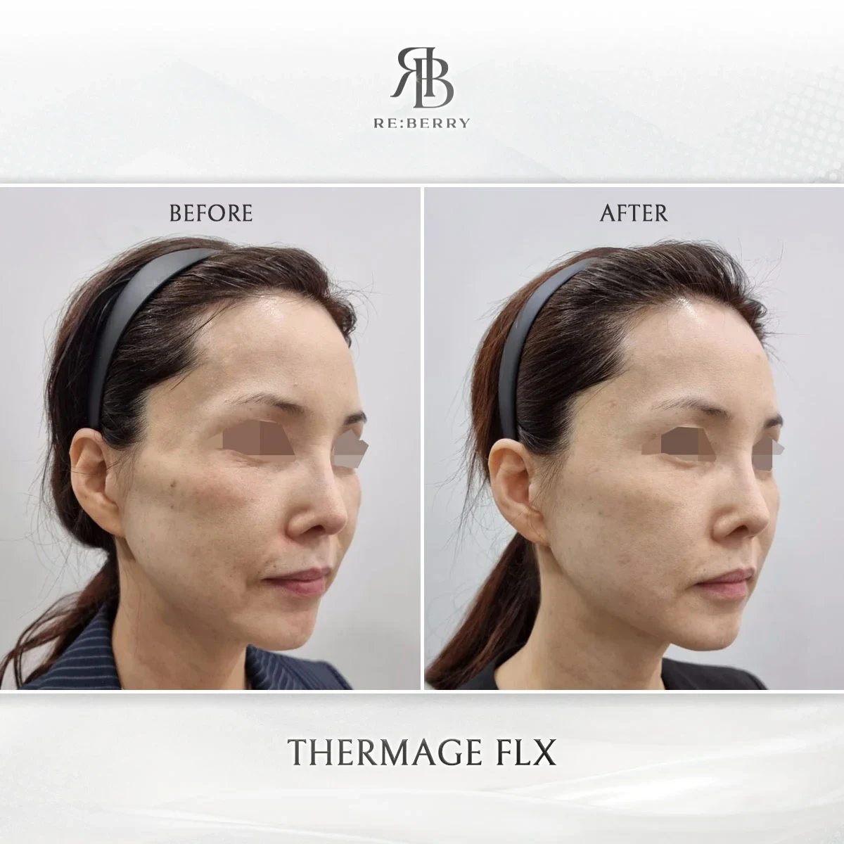 Before and after lifting treatment result at RE:BERRY Gangnam Aesthetic Clinic Seoul — real patient photo