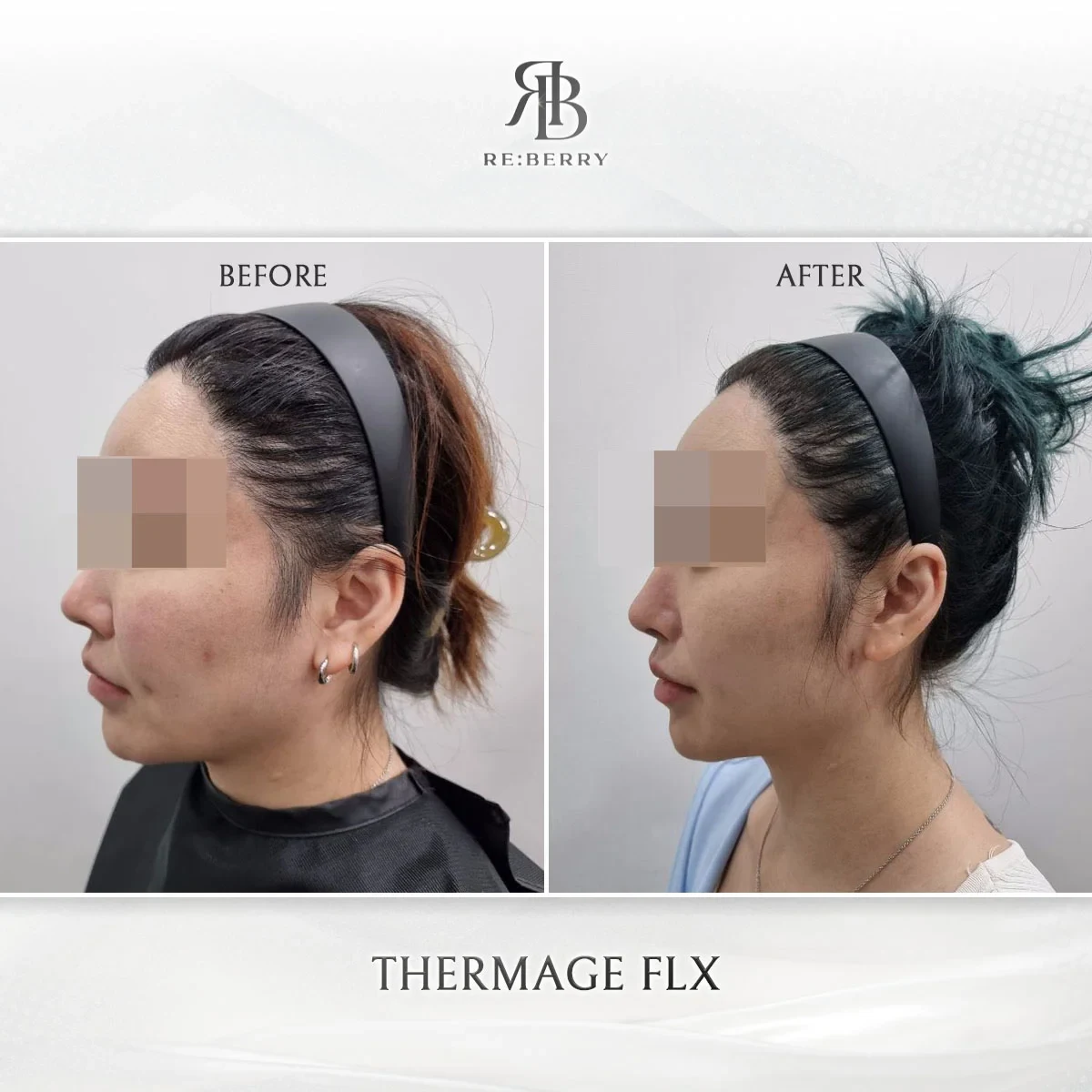 Before and after lifting treatment result at RE:BERRY Gangnam Aesthetic Clinic Seoul — real patient photo