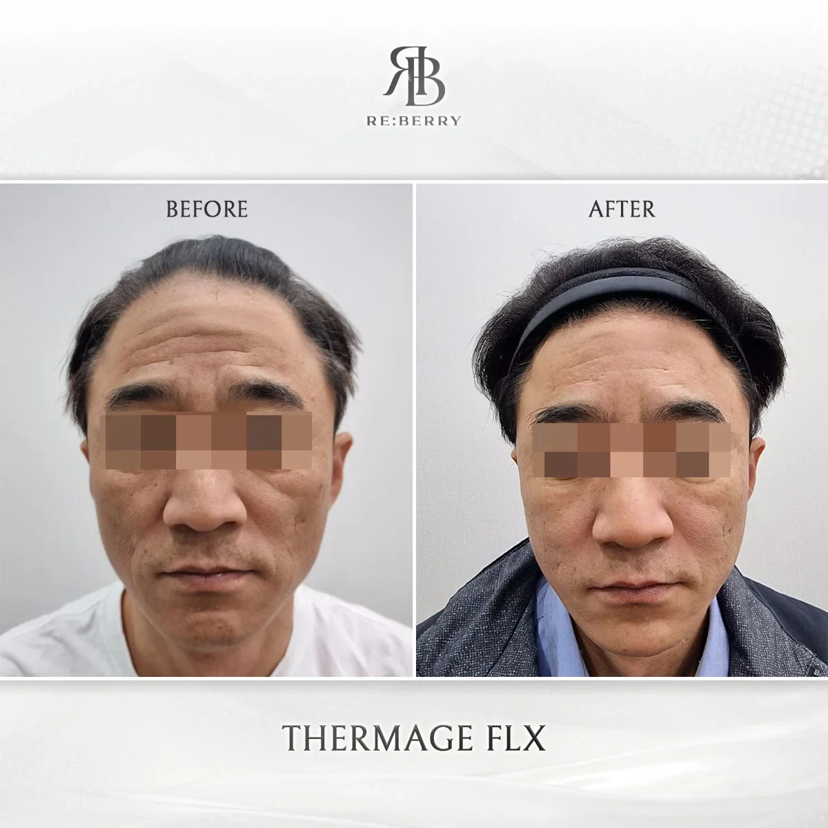 Before and after lifting treatment result at RE:BERRY Gangnam Aesthetic Clinic Seoul — real patient photo