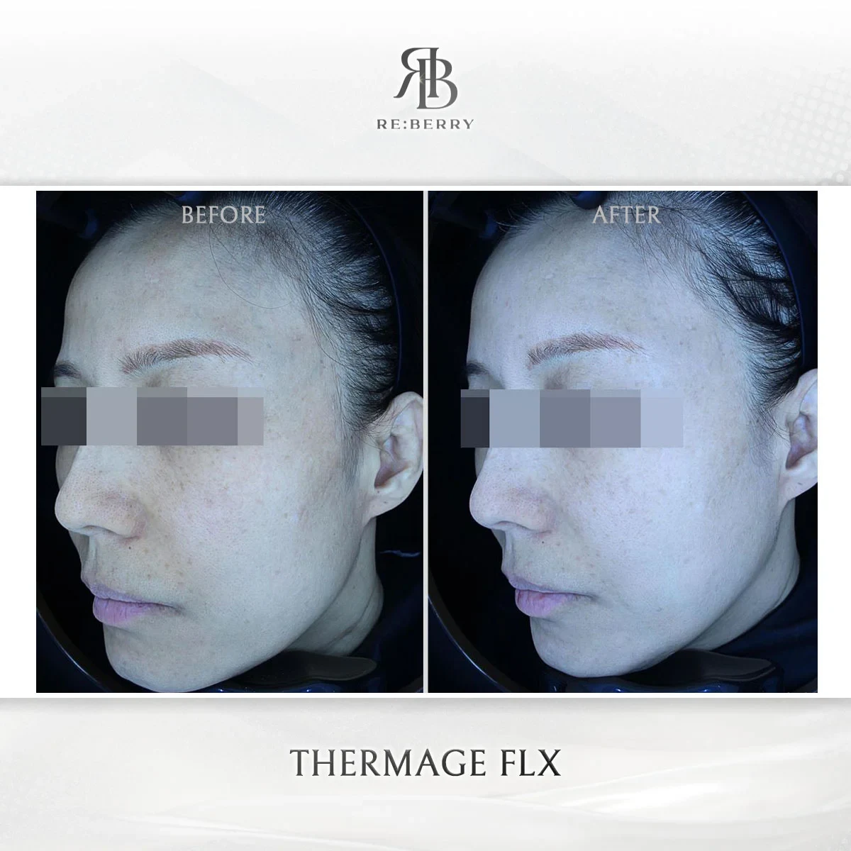 RE:BERRY กังนัม Thermage FLX before & after