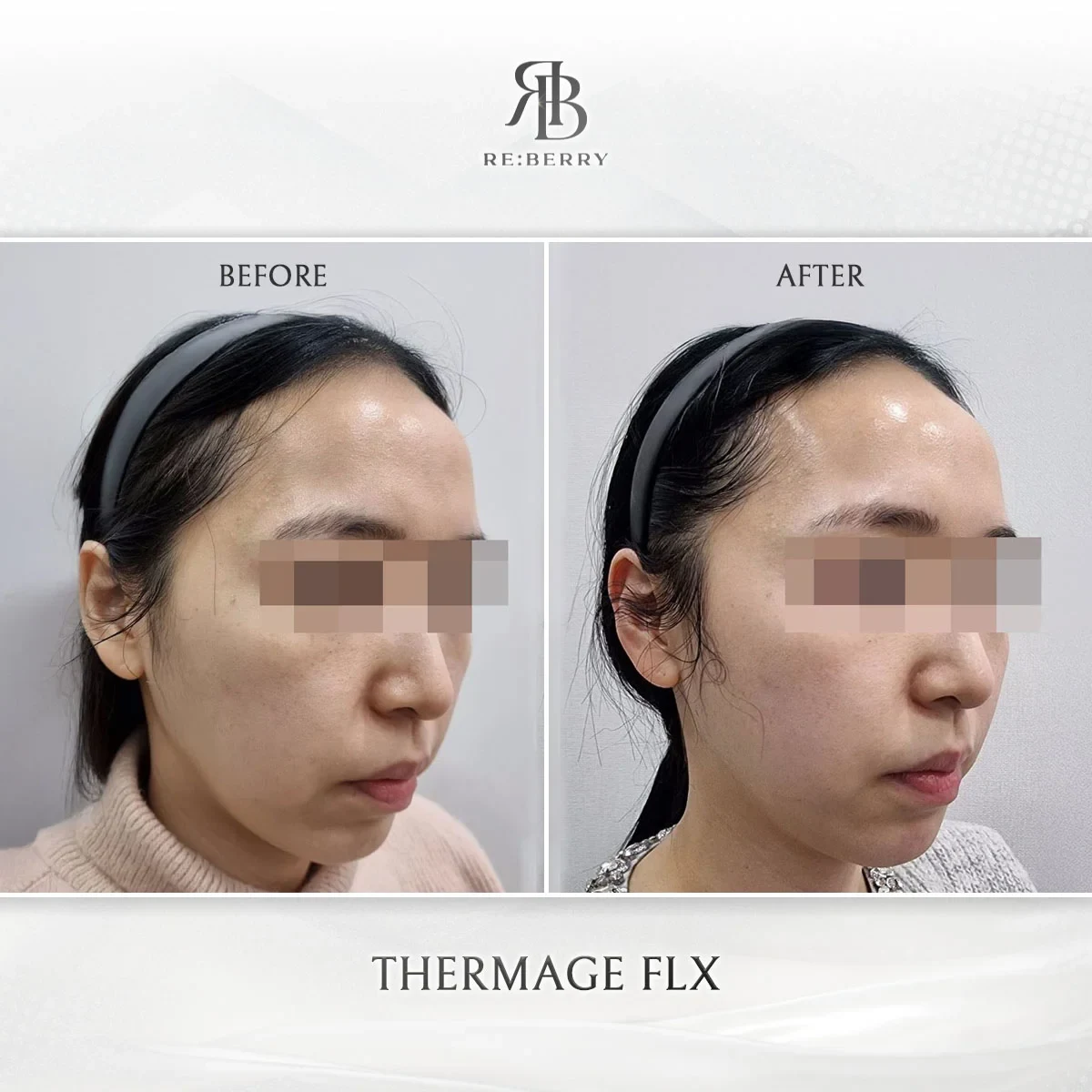 Before and after lifting treatment result at RE:BERRY Gangnam Aesthetic Clinic Seoul — real patient photo