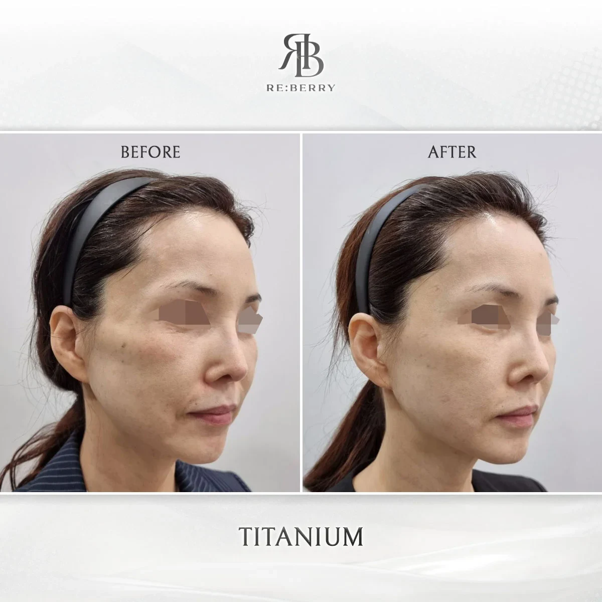 Before and after lifting treatment result at RE:BERRY Gangnam Aesthetic Clinic Seoul — real patient photo