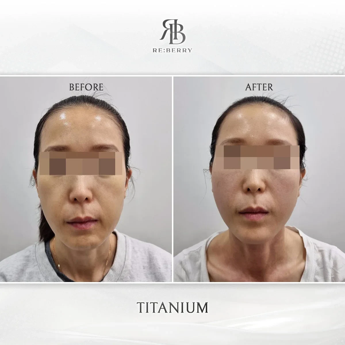 Before and after lifting treatment result at RE:BERRY Gangnam Aesthetic Clinic Seoul — real patient photo