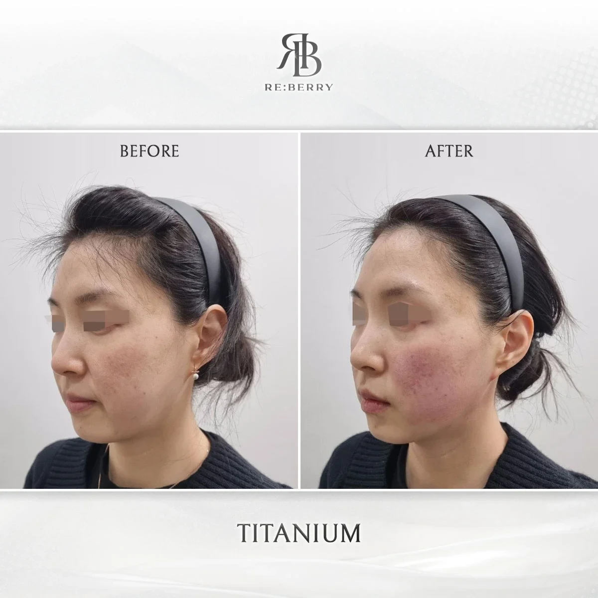 Before and after lifting treatment result at RE:BERRY Gangnam Aesthetic Clinic Seoul — real patient photo