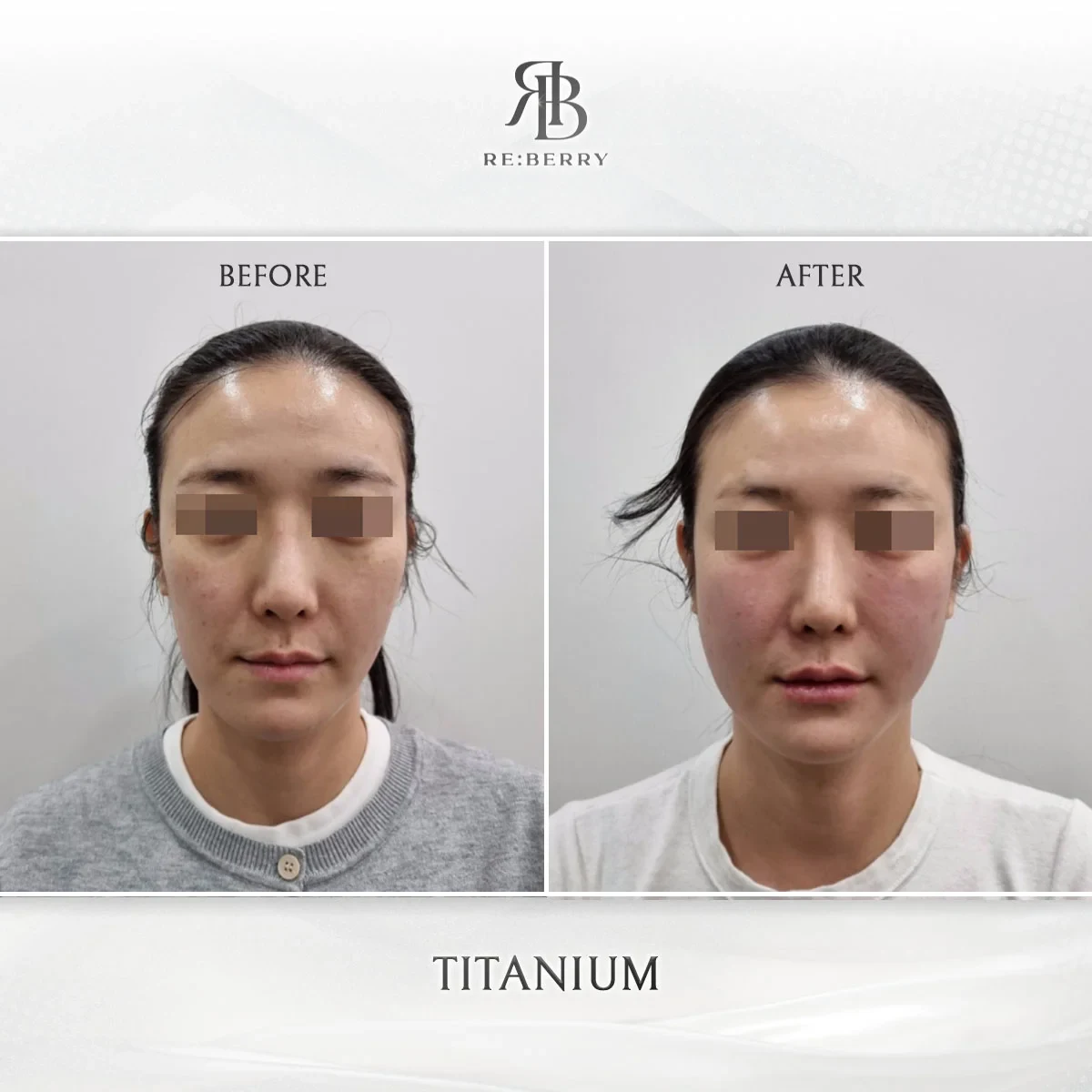 Before and after lifting treatment result at RE:BERRY Gangnam Aesthetic Clinic Seoul — real patient photo