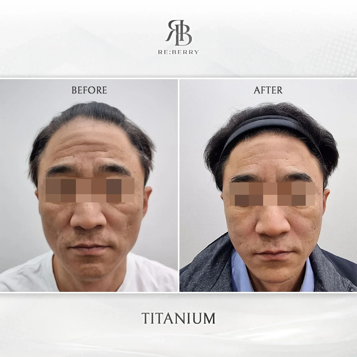 Before and after lifting treatment result at RE:BERRY Gangnam Aesthetic Clinic Seoul — real patient photo