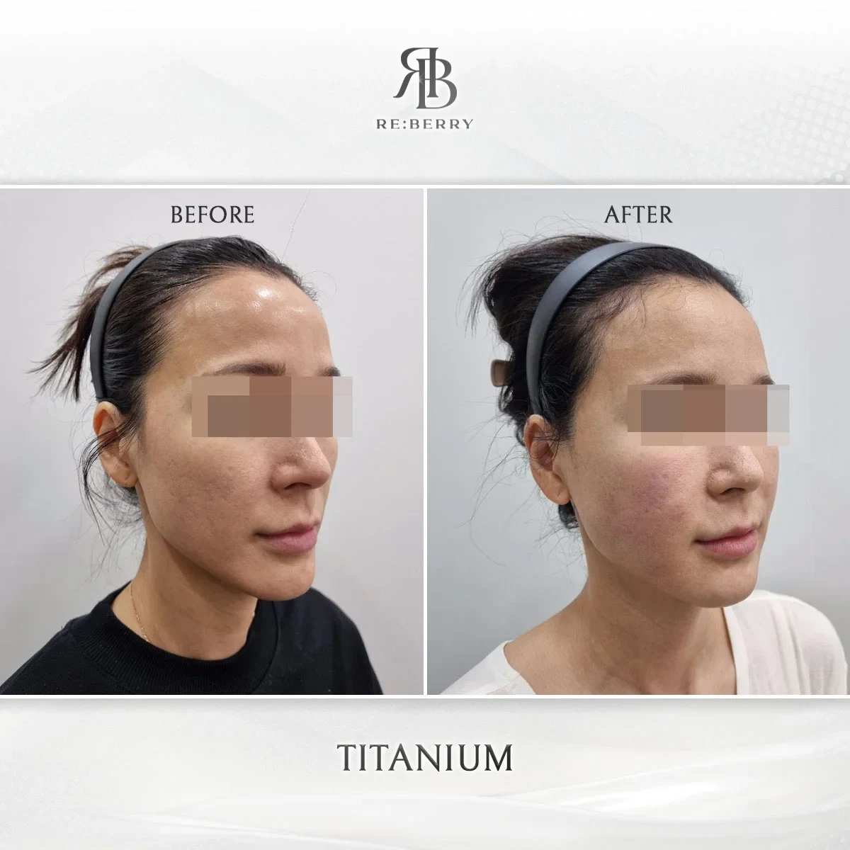 Before and after lifting treatment result at RE:BERRY Gangnam Aesthetic Clinic Seoul — real patient photo