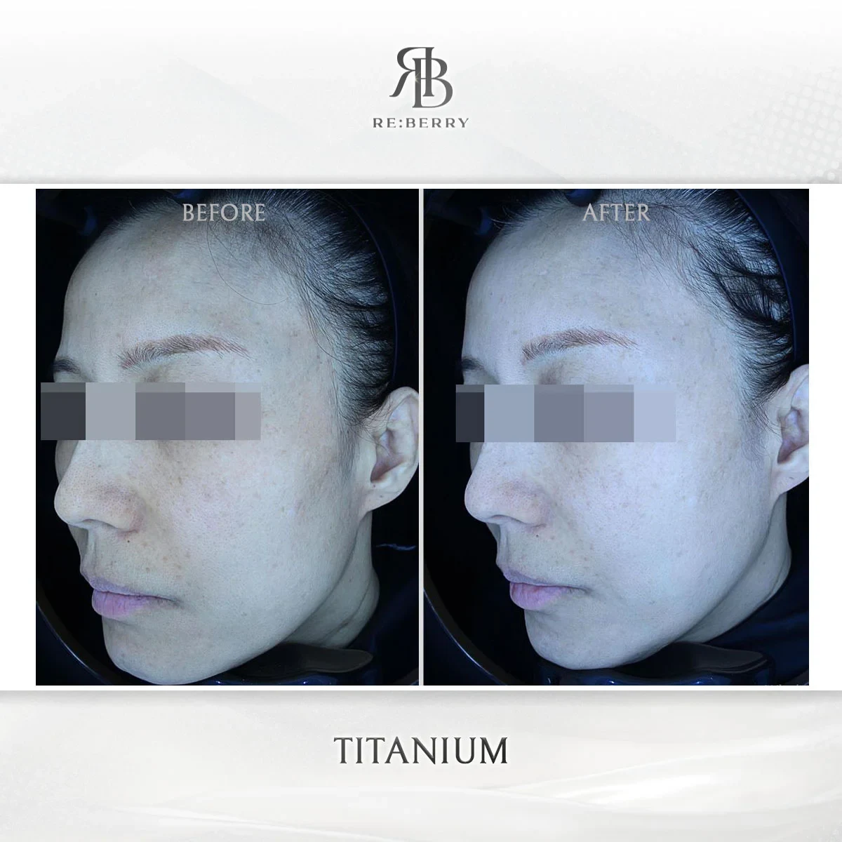 Before and after lifting treatment result at RE:BERRY Gangnam Aesthetic Clinic Seoul — real patient photo