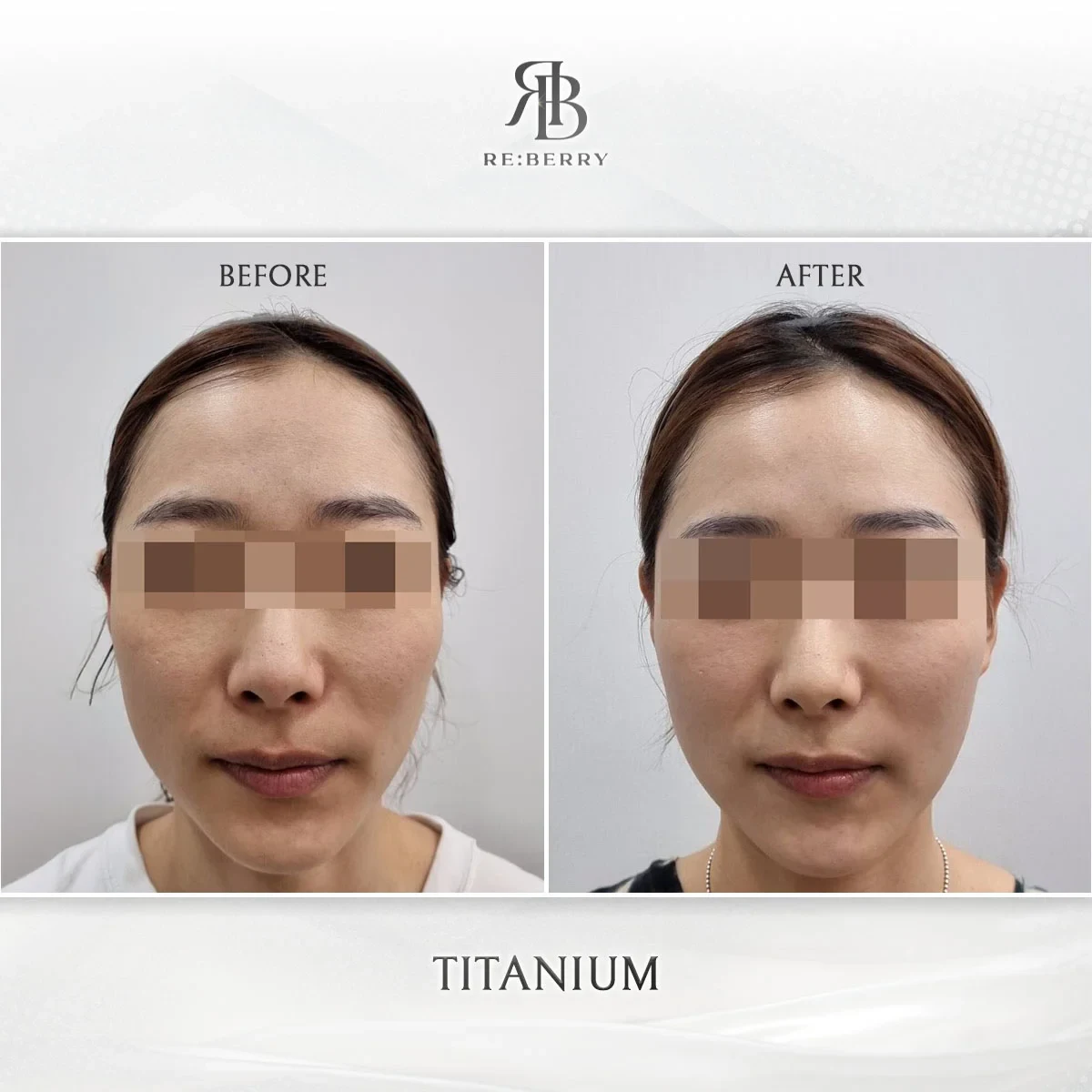 Before and after lifting treatment result at RE:BERRY Gangnam Aesthetic Clinic Seoul — real patient photo