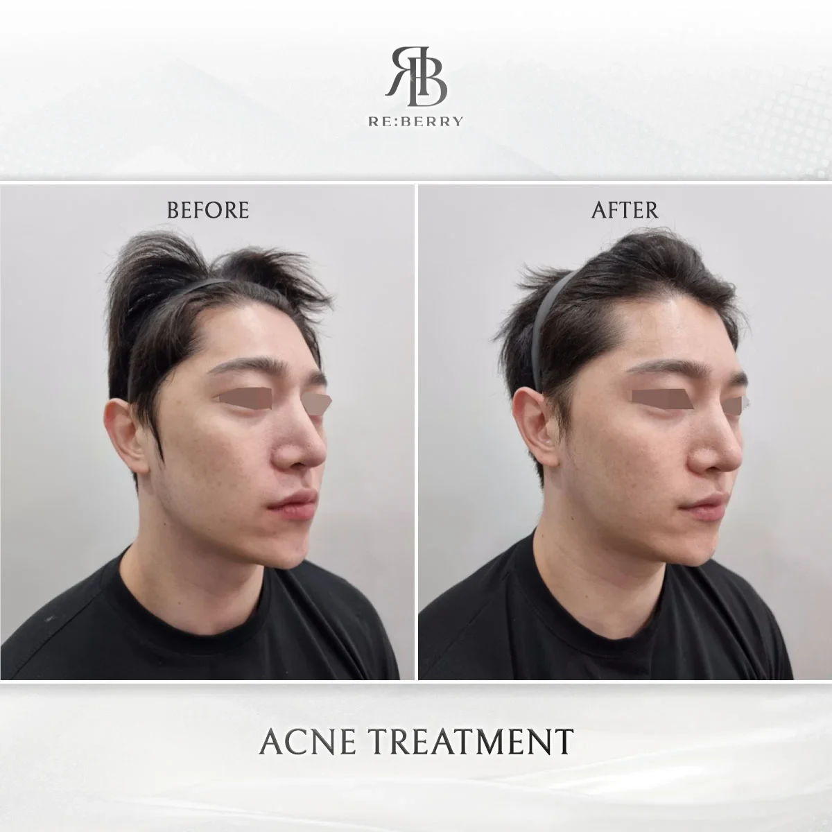 Before and after skin & laser treatment result at RE:BERRY Gangnam Aesthetic Clinic Seoul — real patient photo