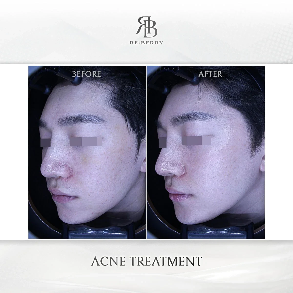 Before and after skin & laser treatment result at RE:BERRY Gangnam Aesthetic Clinic Seoul — real patient photo