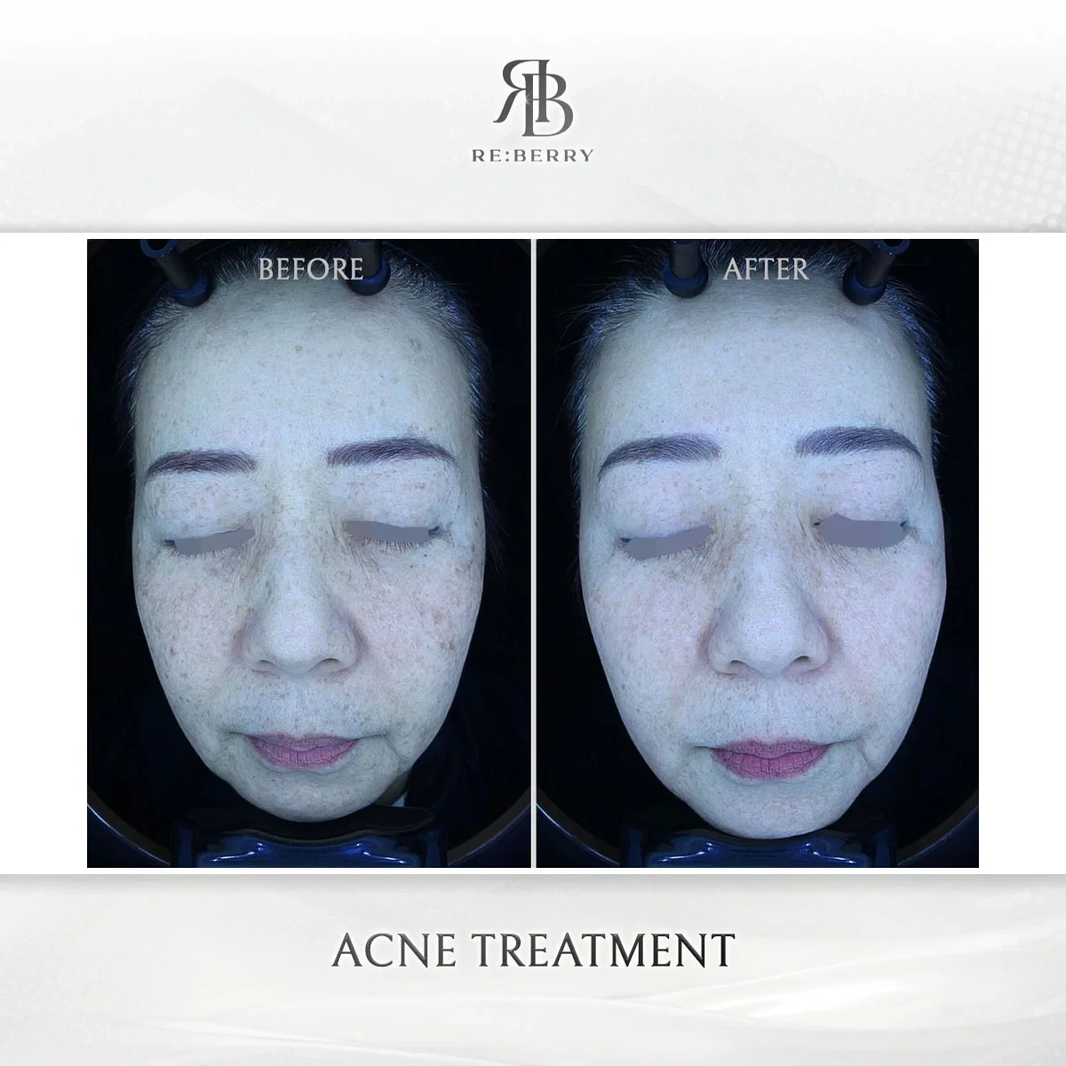 Before and after skin & laser treatment result at RE:BERRY Gangnam Aesthetic Clinic Seoul — real patient photo
